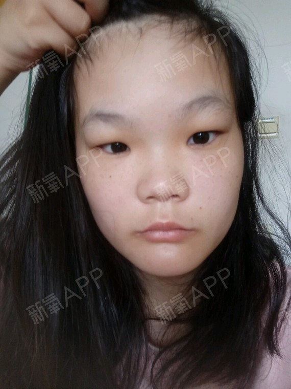 割双眼皮电子烟_双眼皮术后可以抽电子烟吗_全切双眼皮抽电子烟